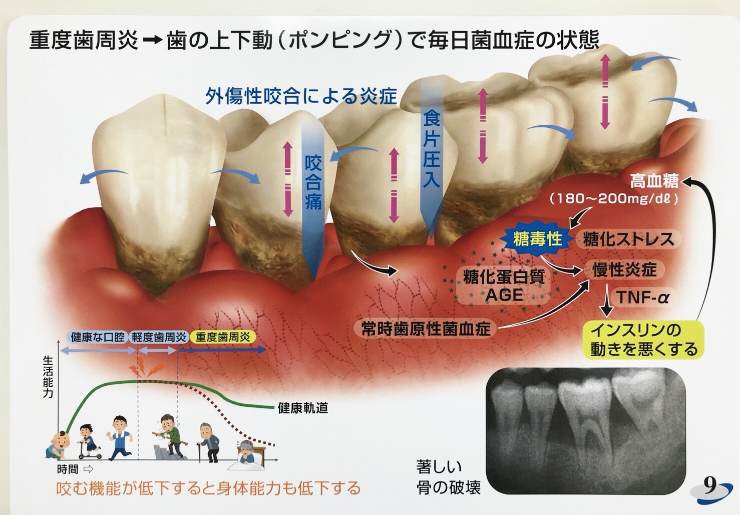 歯茎 の 潰瘍