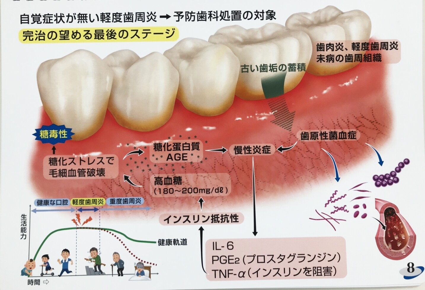 歯周病