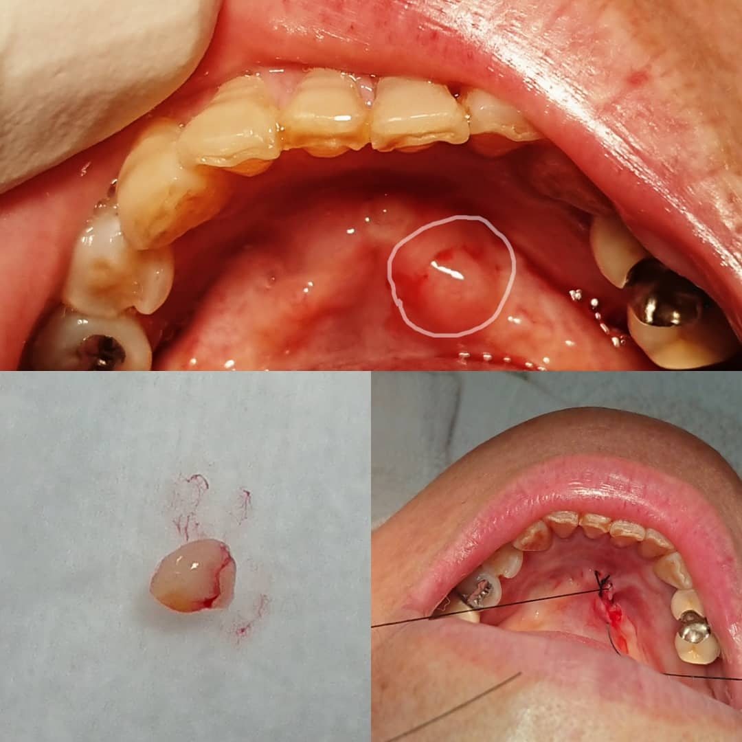 手術 歯根 嚢胞