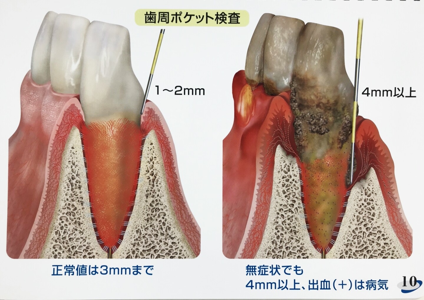 歯周病