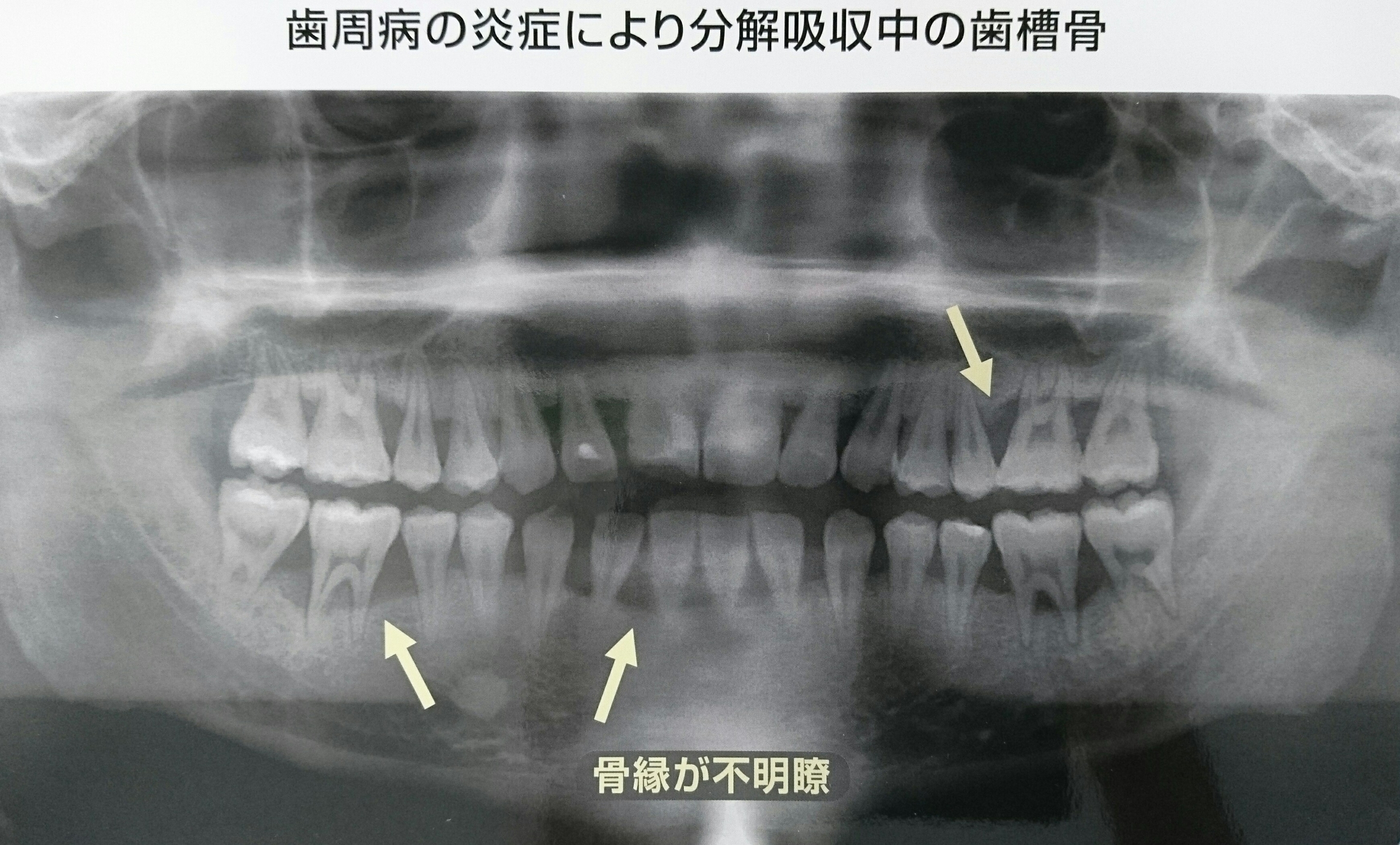 レントゲン