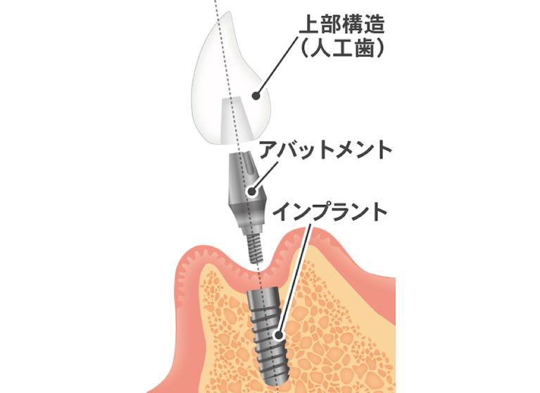 インプラント治療